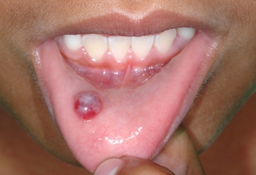 Mucocele