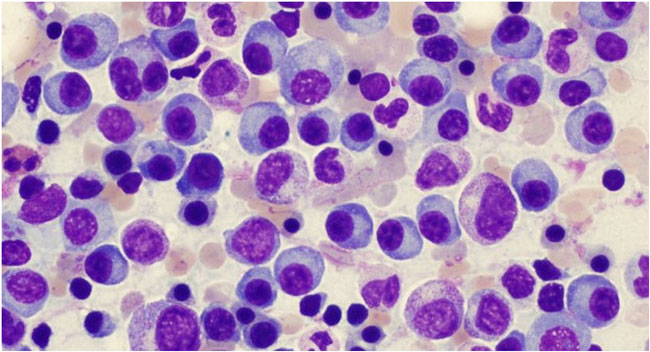 Mieloma múltiple: la innovación en los tratamientos impulsa pronósticos alentadores