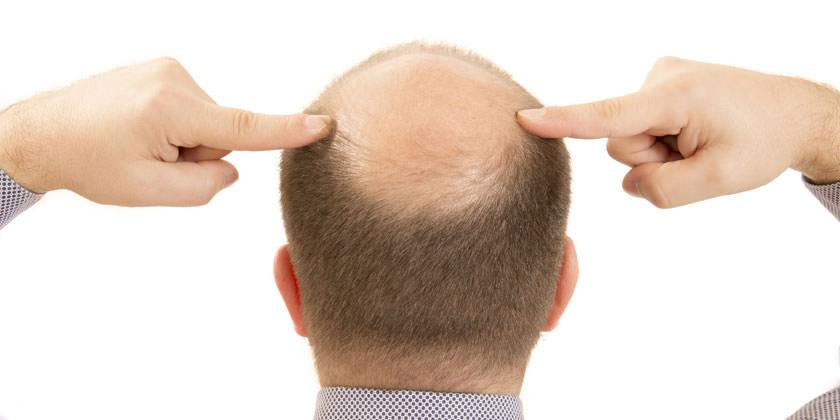 Alopecia