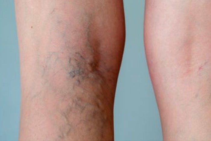 Mitos y verdades sobre la trombosis