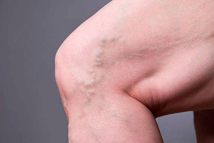 ¿Qué es la trombosis venosa profunda?