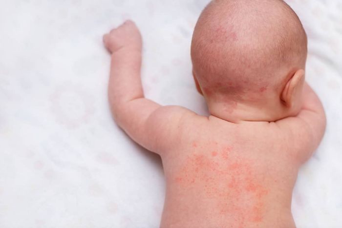 Sudamina, granitos en la piel de los bebés por el calor