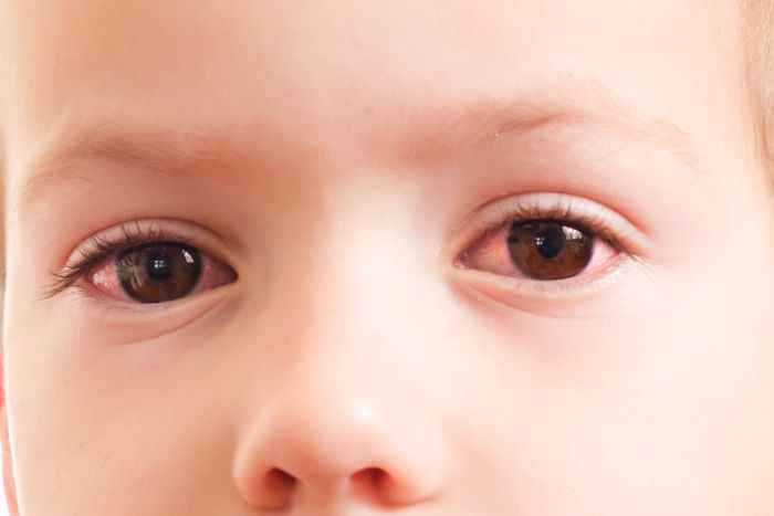 Conjuntivitis víricas en niños. Como evitar su contagio