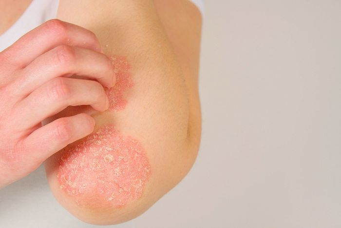 Cómo tratar la psoriasis desde la psicología